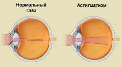 Что такое астигматизм?